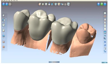 DentCAD設(shè)計(jì)的假牙模型 DentCAD設(shè)計(jì)的假牙模型